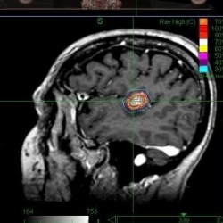 brain-metastasis-2-neurooncology.gr